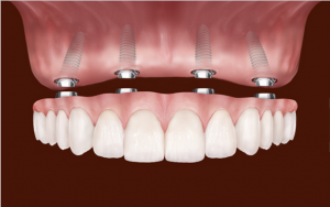 dental-implants-confidental-care